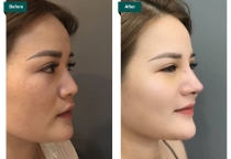 Nâng mũi bao lâu thì được cúi đầu?