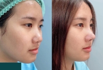 Nâng mũi cấu trúc và bán cấu trúc khác nhau như nào?