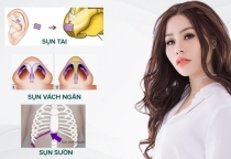 Nâng mũi sụn tự thân và sụn nhân tạo loại nào tốt?