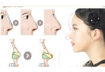 Nâng mũi bán cấu trúc dựng trụ là gì?