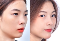 Nâng mũi bao lâu thì đầu mũi gom lại?