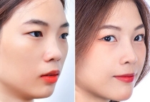 Mũi tẹt cánh mũi to có nên sửa lại không?