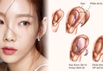 Nâng mũi sụn tự thân có bị teo lại không?