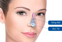 Nâng mũi sụn tai có vĩnh viễn không?