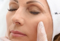 Nâng mũi cấu trúc có tháo ra được không?