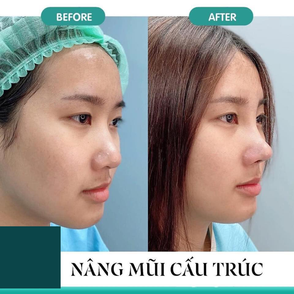 Nâng mũi cấu trúc và bán cấu trúc khác nhau như nào?