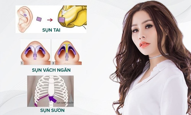 Nâng mũi sụn tự thân và sụn nhân tạo loại nào tốt?
