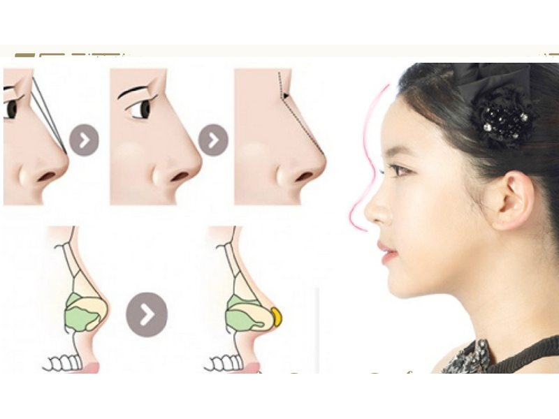 Nâng mũi bán cấu trúc dựng trụ là gì?