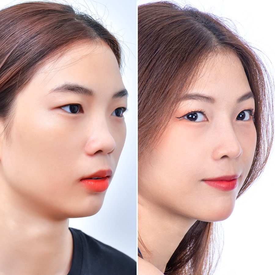 Nâng mũi bao lâu thì đầu mũi gom lại?