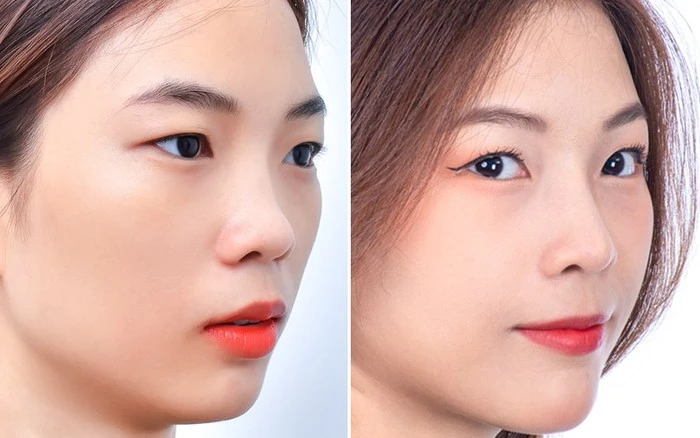 Mũi tẹt cánh mũi to có nên sửa lại không?