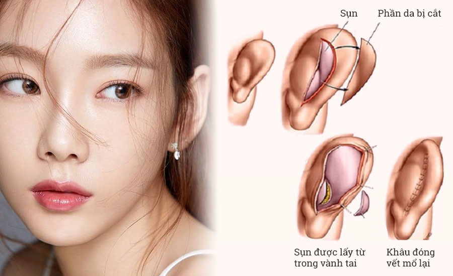 Nâng mũi sụn tự thân có bị teo lại không?