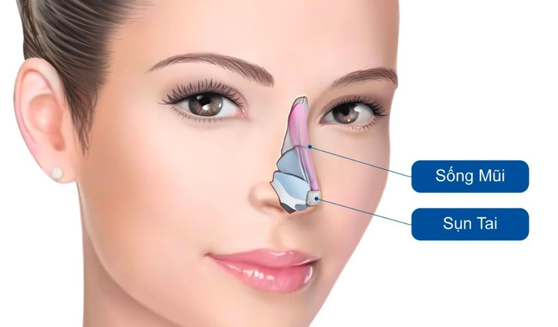 Nâng mũi sụn tai có vĩnh viễn không?