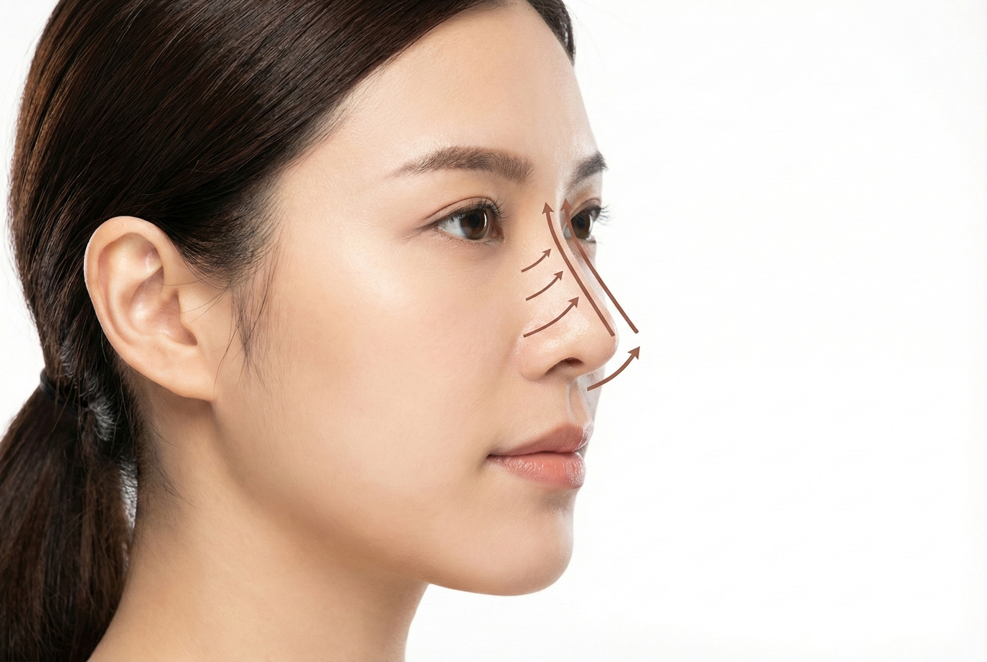 Nâng Mũi Sụn Silicon